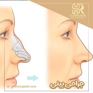 جراحی بینی - دکتر شاهین رجائیه