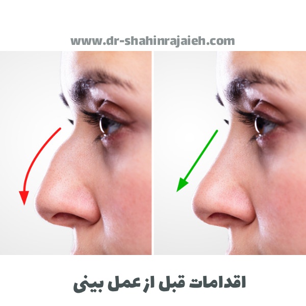 اقدامات قبل از عمل بینی