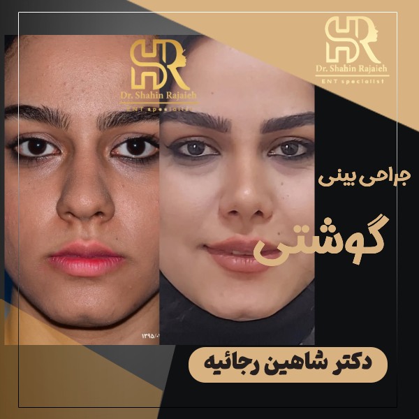 جراحی بینی گوشتی