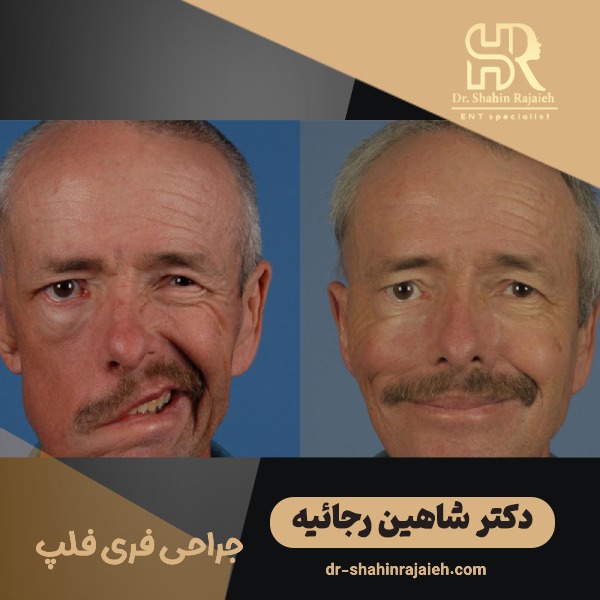 جراحی فری فلپ