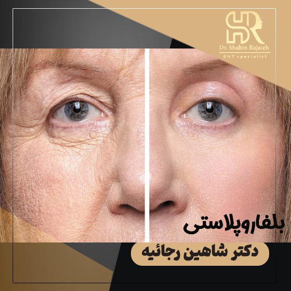 بلفاروپلاستی