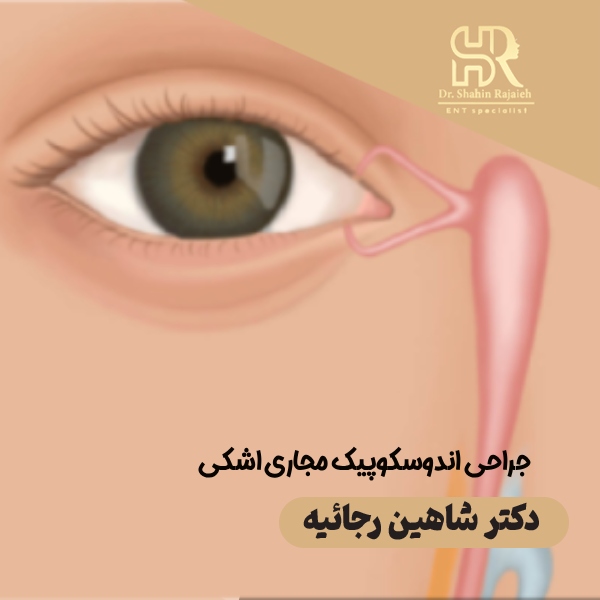 جراحی اندوسکوپیک مجاری اشکی