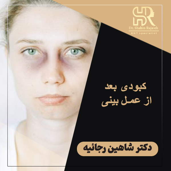 کبودی بعد از عمل بینی