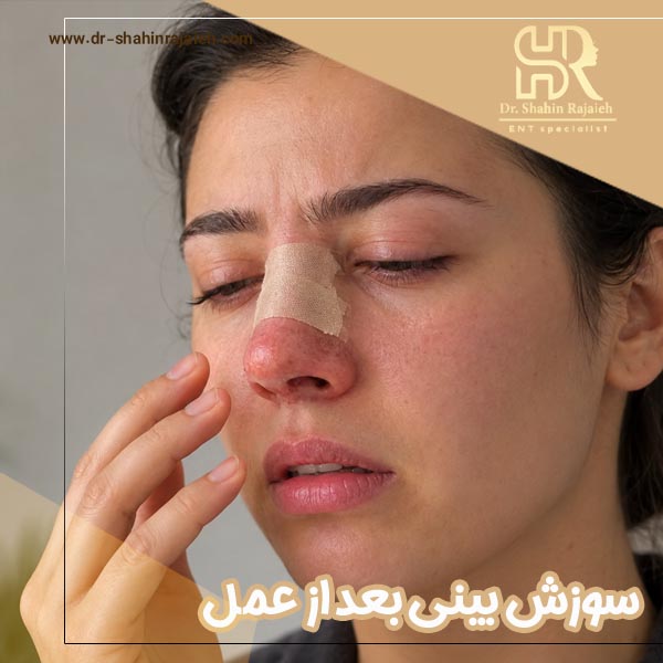 سوزش بینی بعد از عمل